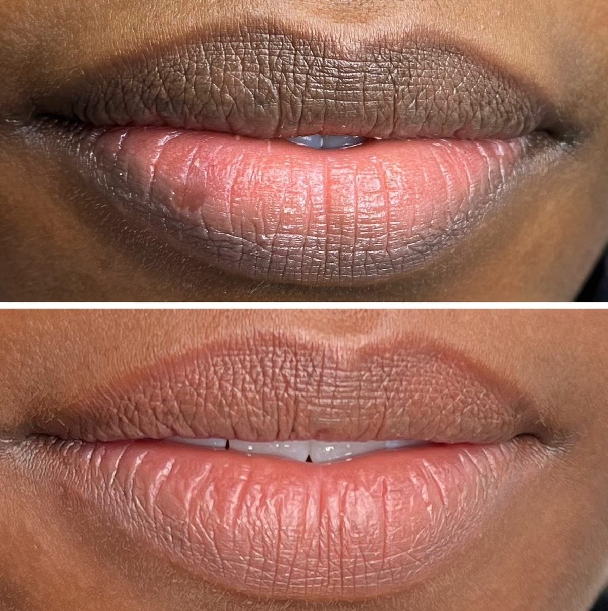 Before and after Dark Lip Neutralisation by Kate Dark