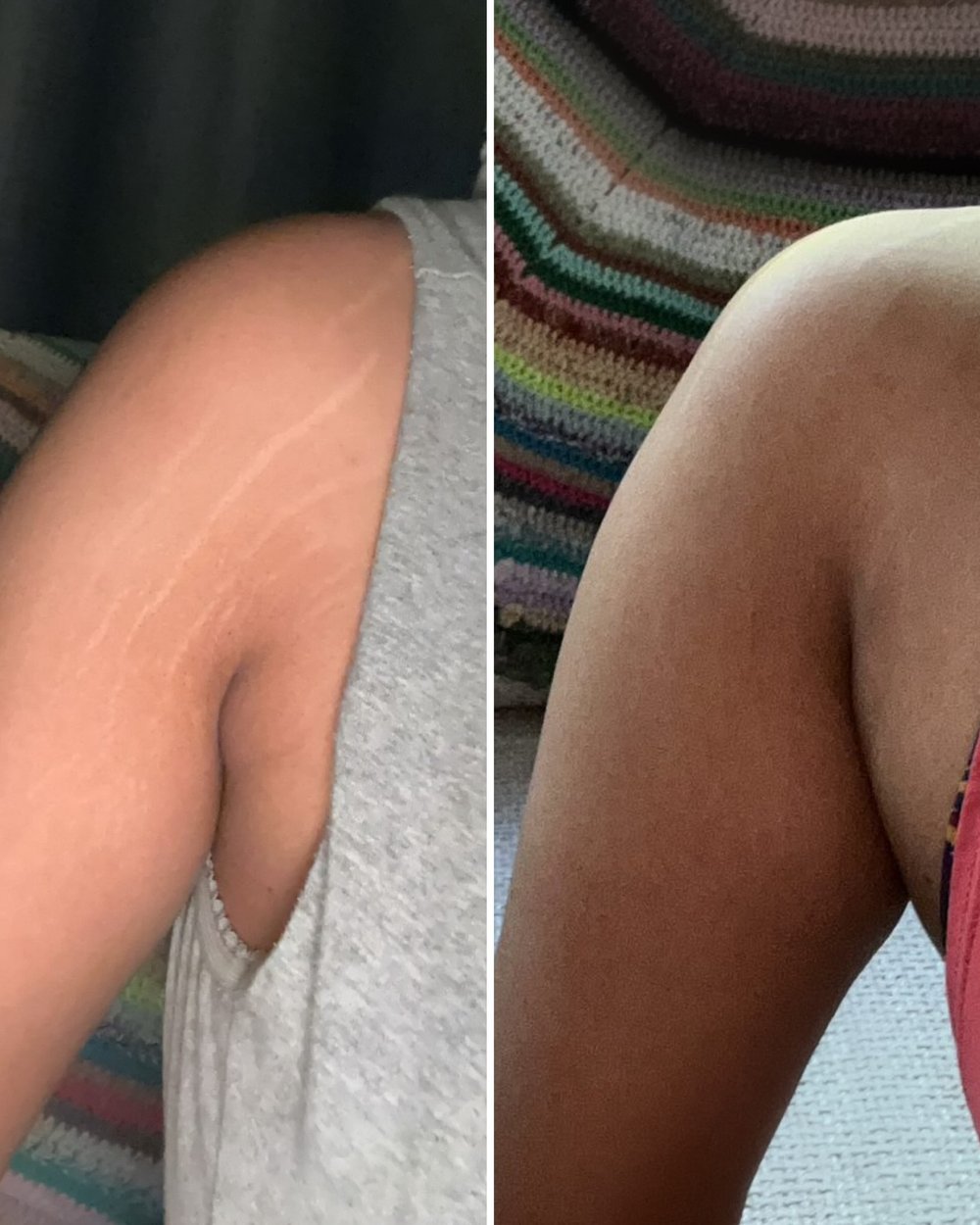 Before and after stretch mark camouflage tattoo by Kate Dark