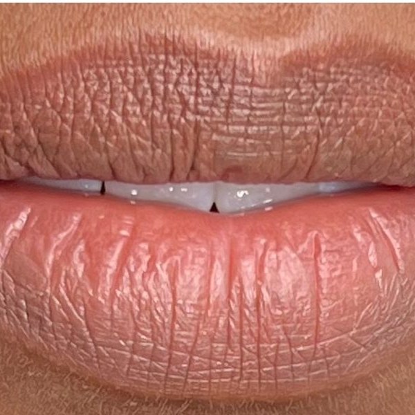 Dark Lip Neutralisation result by Kate Dark