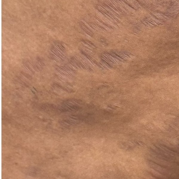 Scar and stretch mark camouflage result by Kate Dark