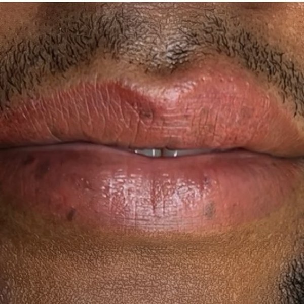 Vitiligo camouflage result by Kate Dark